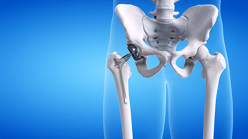 hip replacement