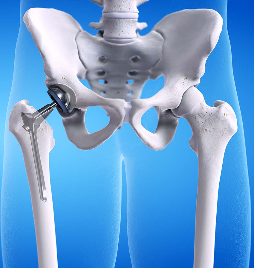 hip replacement